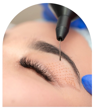 Blepharoplastie laser Tunisie